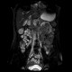 Polyp in jejunum, jejunal polyps, polyposis: MRI - Magnetic Resonance Imaging